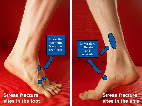 Common stress fracture sites in the foot and shin