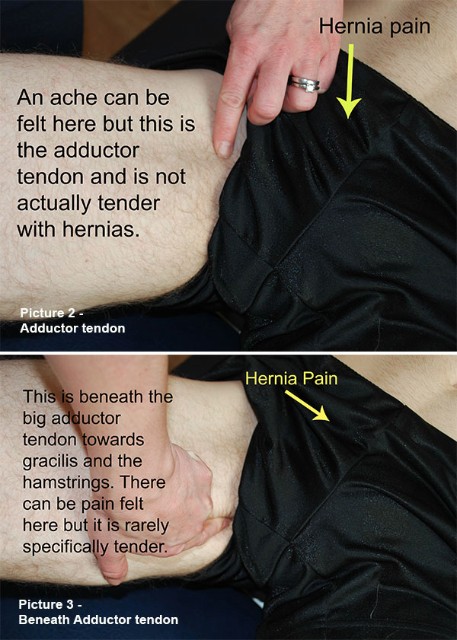 Adductor tendon and Beneath Adductor tendon