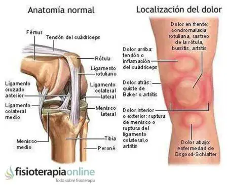 Photo of Causas y tratamiento para el dolor de rodilla (pata de ganso)