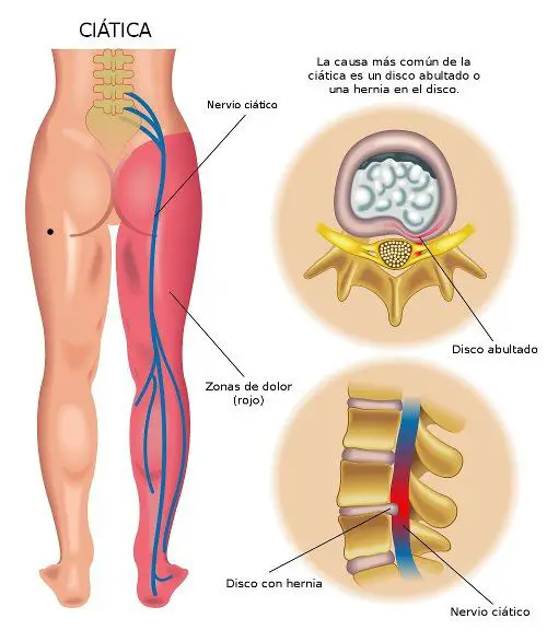 Photo of Dolor de espalda baja – Nervios